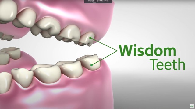 Wisdom Teeth